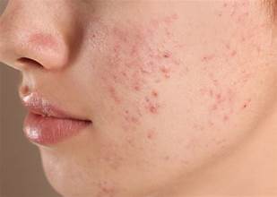 Acne & Oily Skin - Botika Skincare