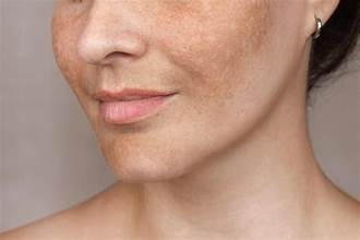 Hyperpigmentation - Botika Skincare
