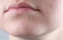 Dry Skin